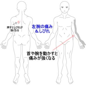 しびれ 腕 手 はりの症例 うめの手鍼灸院 うめの手鍼灸院 ー 子供からお年寄りまで安心 秦野市の鍼 はり 専門院